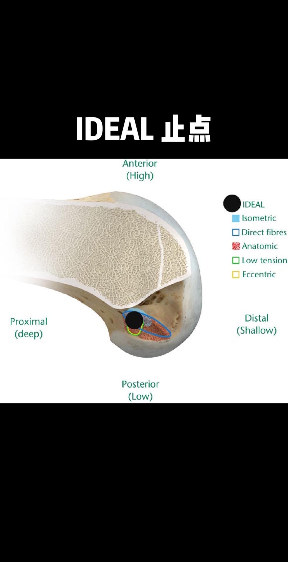 IDEAL 止点。前交叉重建，股骨隧道的最佳位置I.D.E.A.L点。...
