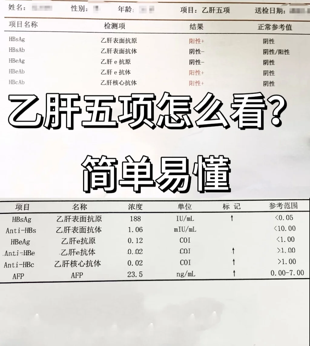 乙肝五项怎么看？简单易懂 ﻿山东﻿ ﻿健康科普﻿ ﻿乙肝﻿ ﻿乙肝五项...