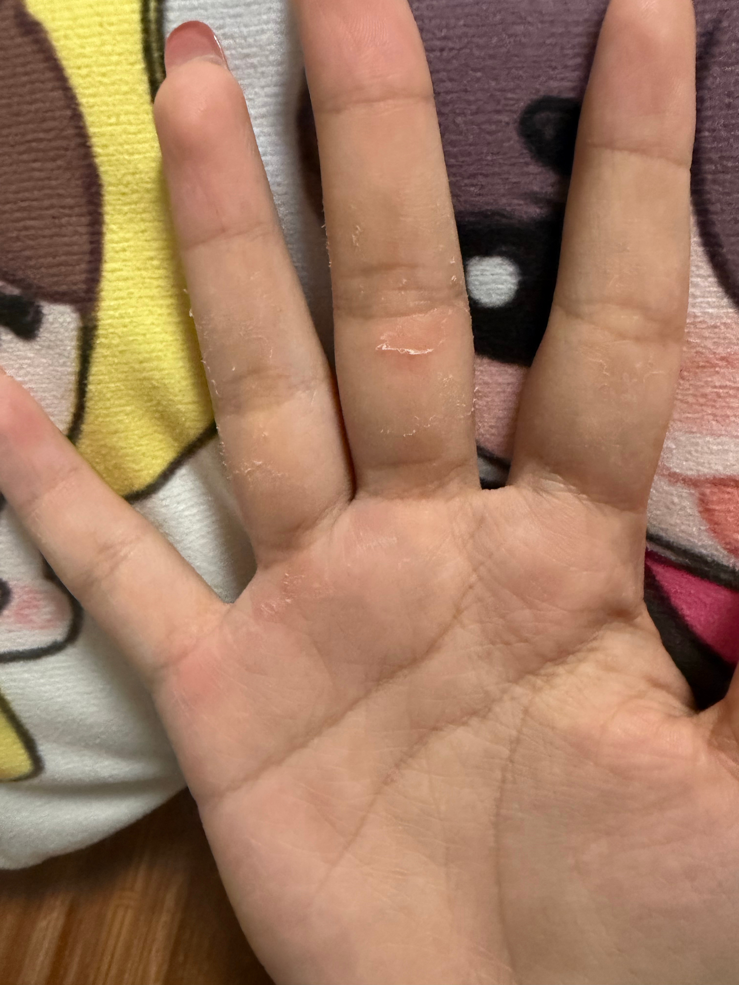 我手咋掉皮成这样了