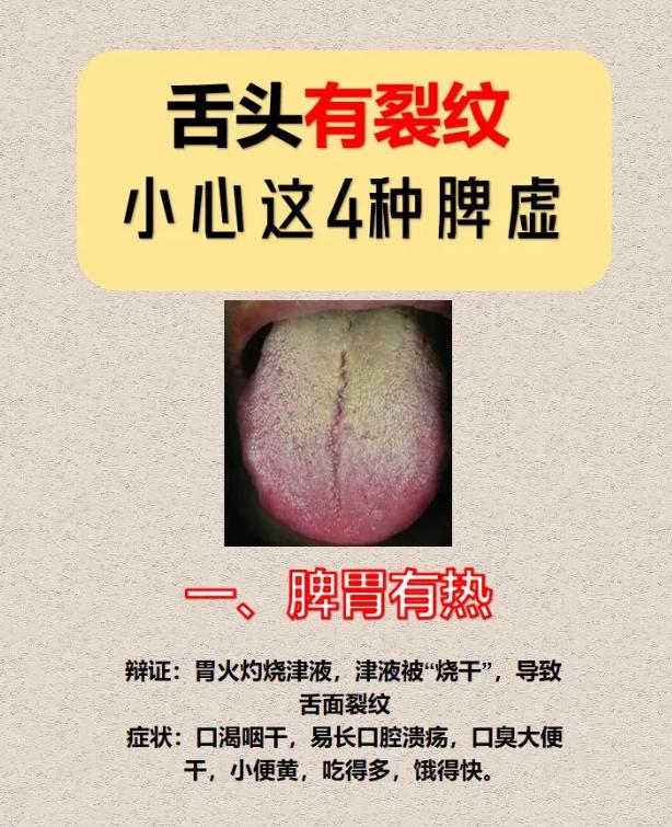 舌面有裂纹，可能和这几种脾虚有关