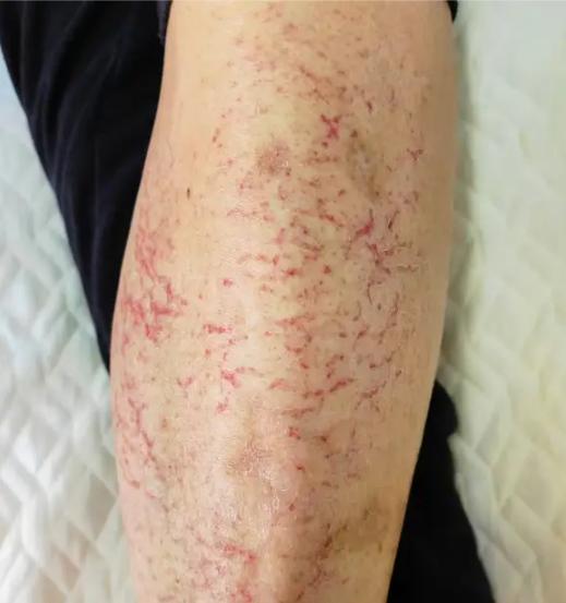 悲剧还是发生了！近日，湖南长沙，一女子连续打了三天麻将，回家后便感觉小腿不对劲，