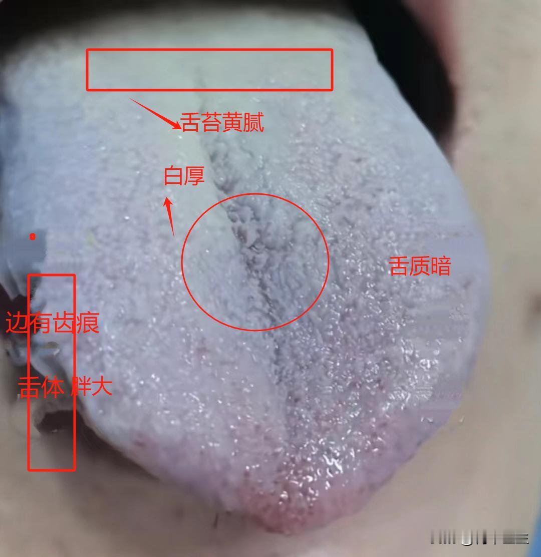 寒湿不难祛，难的是湿盛化瘀

患者主诉：口淡无味，神倦乏力，四肢怕冷、困重，气短