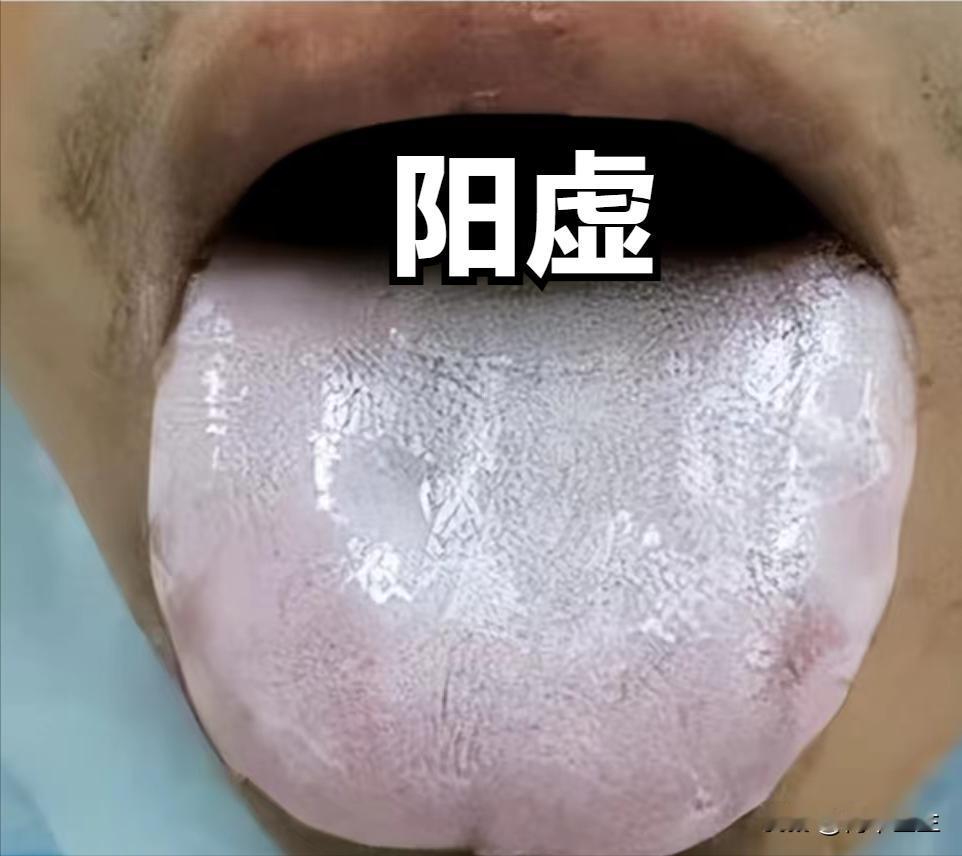 舌头能体现出来的四种虚

（一）阳虚
症状：舌质淡白、舌体胖大，多伴有畏寒怕冷、