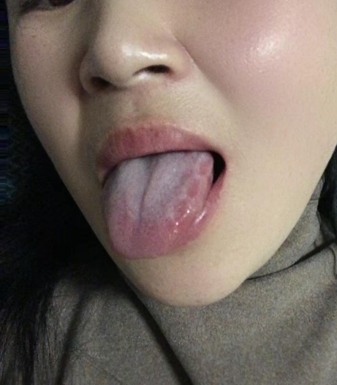 碰见一位病友，长得非常漂亮[惊喜]，舌头却不敢看[捂脸]
又是上火，又是怕冷的，