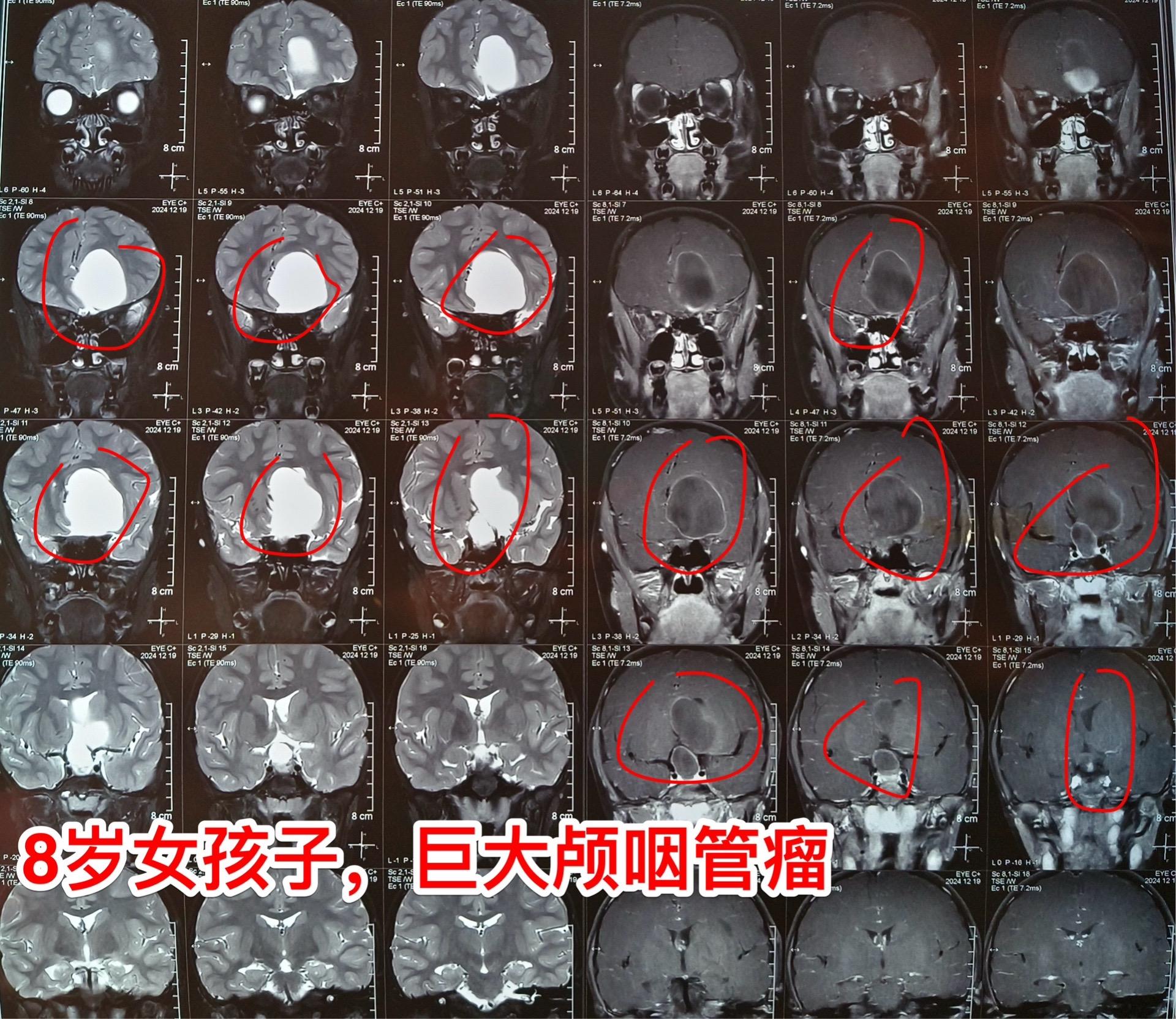 巨大颅咽管瘤-8岁女孩子，今天住院了。河南省许昌市女孩子，8岁，视力下...