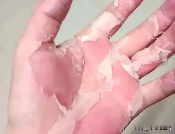 在线求助：请大家帮帮忙！[祈祷]
我的手每年春天和冬天就会这样褪皮，每次整个手像