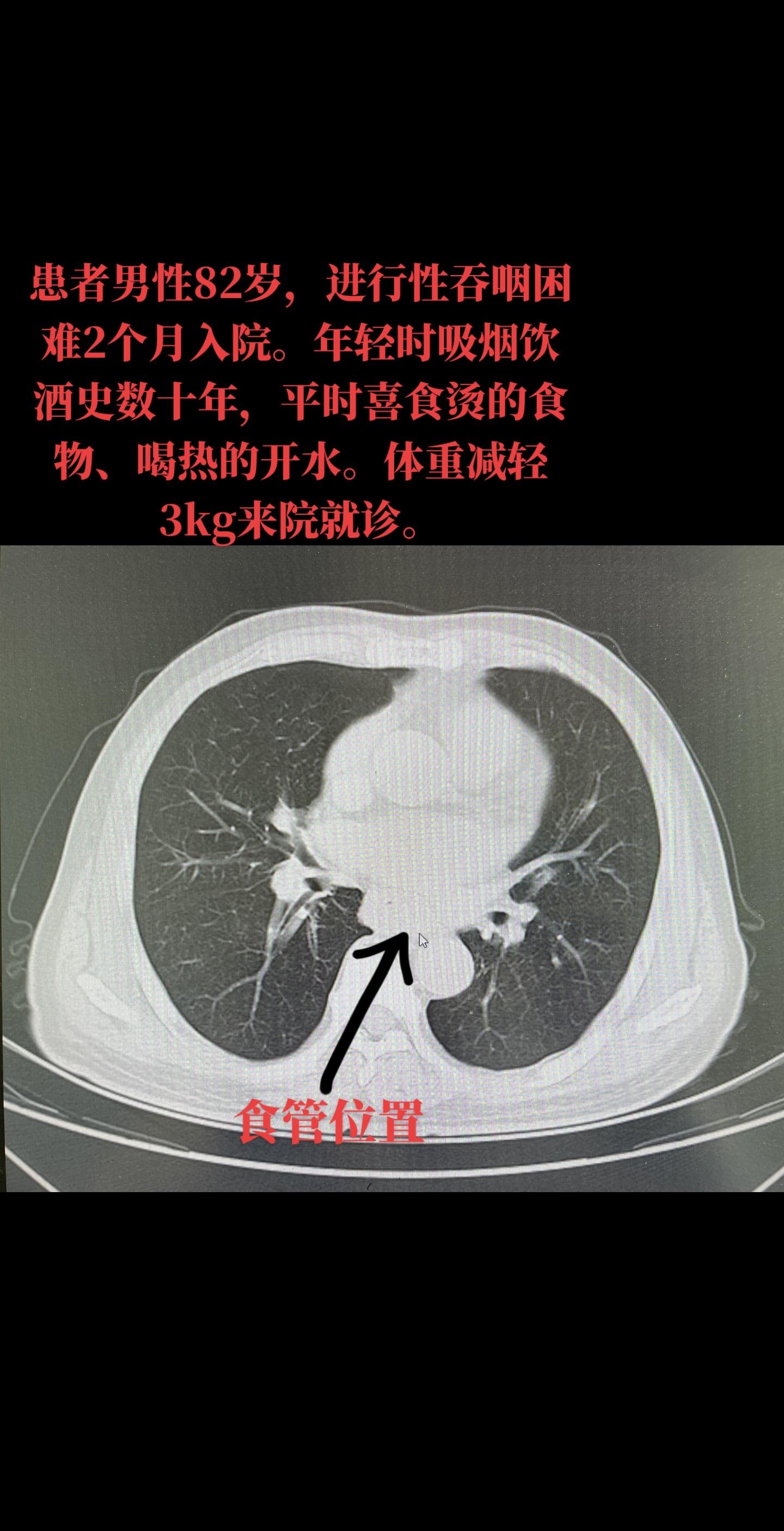 病例分享：进行性吞咽困难，吸烟饮酒史，平时喜食烫的食物、喝过热的开水。胃镜检查并活检示：食道鳞状细胞癌。