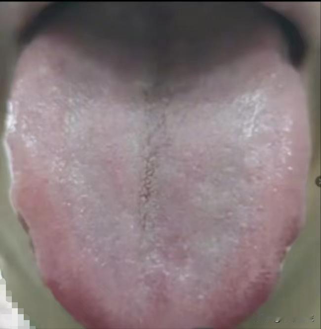 身体湿气重，用参苓白术却没效果？朋友，你的病根在肾，只是健脾没用呀

主诉：乏力