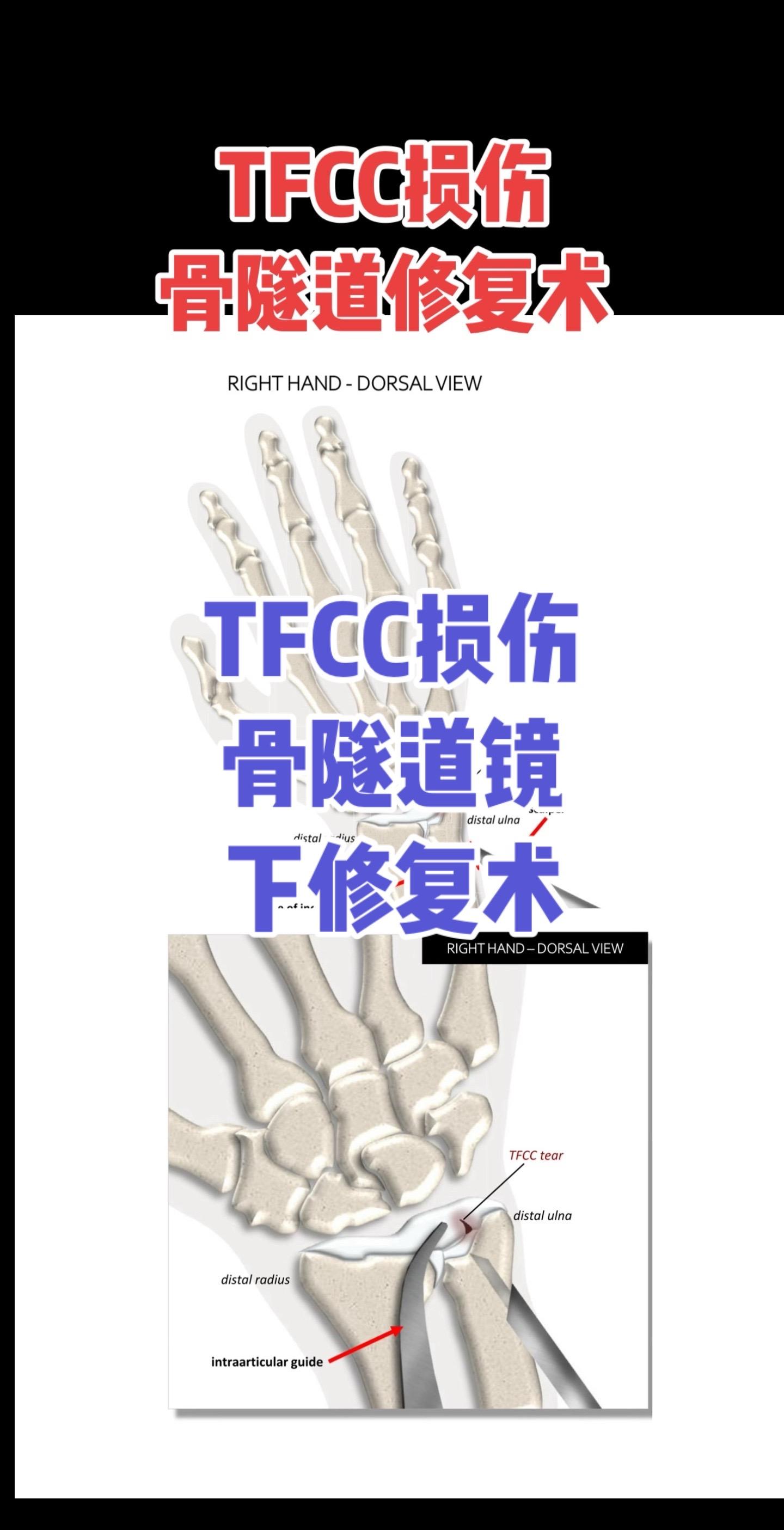 TFCC尺骨凹部骨隧道镜下修复术。TFCC撕裂合并尺骨凹部断裂及远端桡...