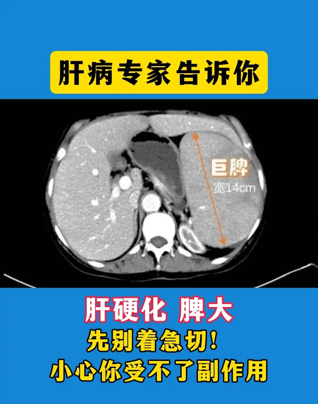 “主任，我后悔切脾了”这是济南的一位42岁的大妹子，一年前彩超提示肝硬...