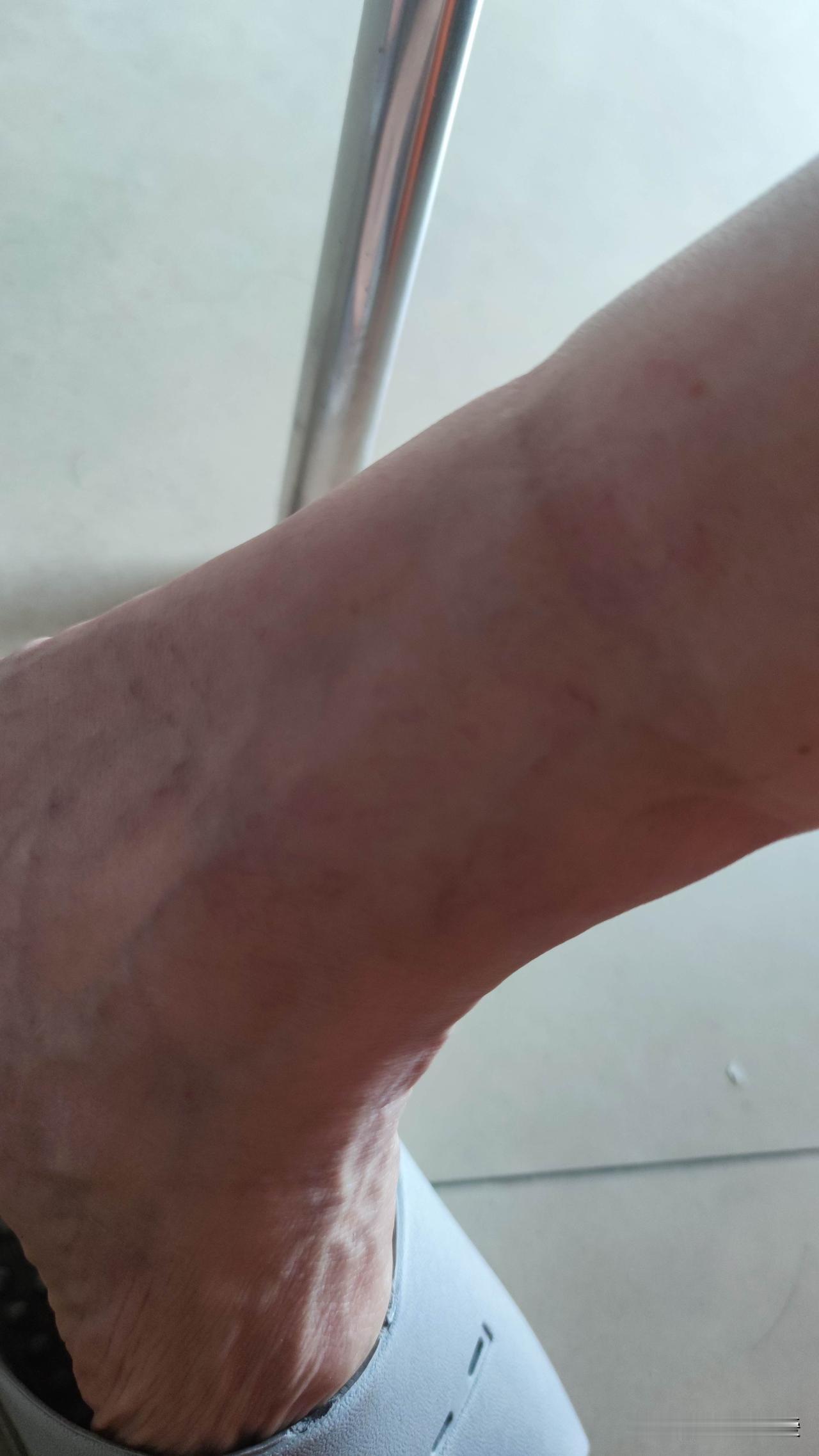 但也可能是身体在“报警”。要是袜印很深，还伴有腿脚发胀，那可能是水肿。水肿原因很