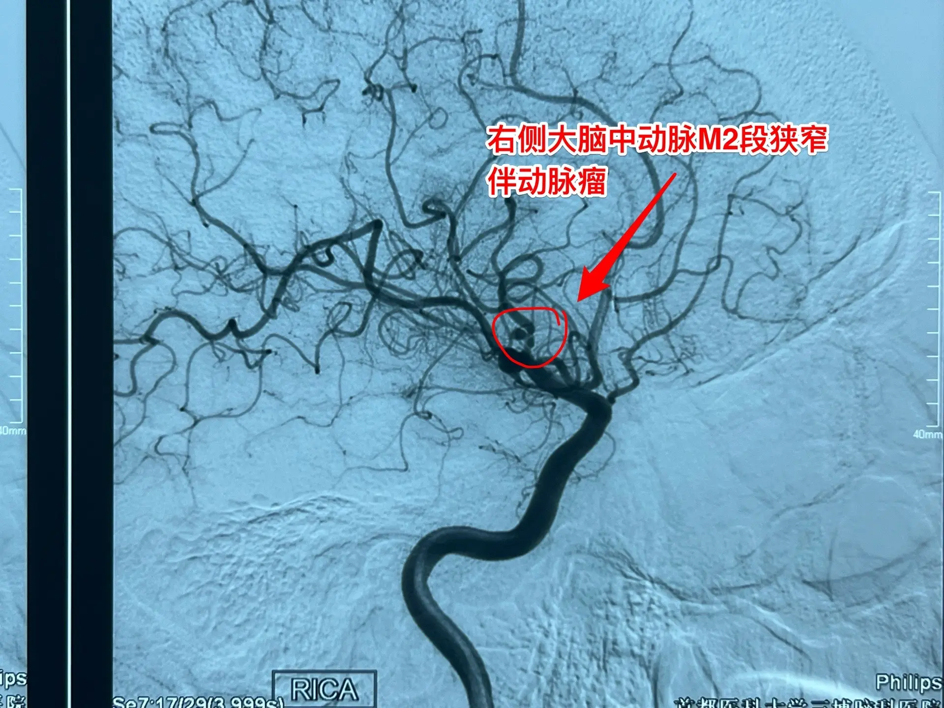 动脉瘤SAH可不是小病，要重视。50岁山西男性，8月19日突发头痛伴呕...