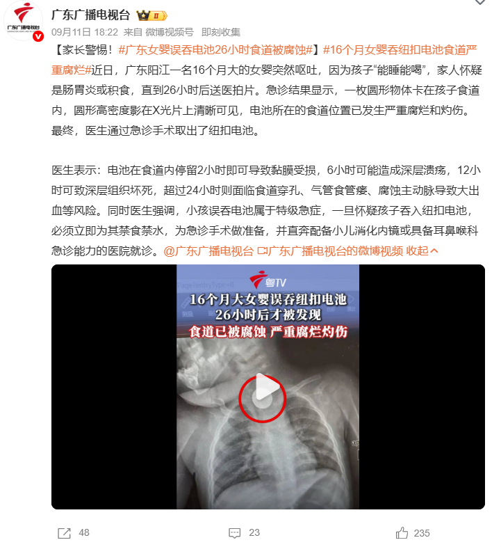 广东女婴误吞电池26小时食道被腐蚀16个月女婴吞纽扣电池食道严重腐烂太惊险了！家