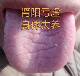 这种裂纹舌，年老体虚者一定要注意，腰膝酸软跑不了！
 
属于脾肾阳虚，精血亏虚，
