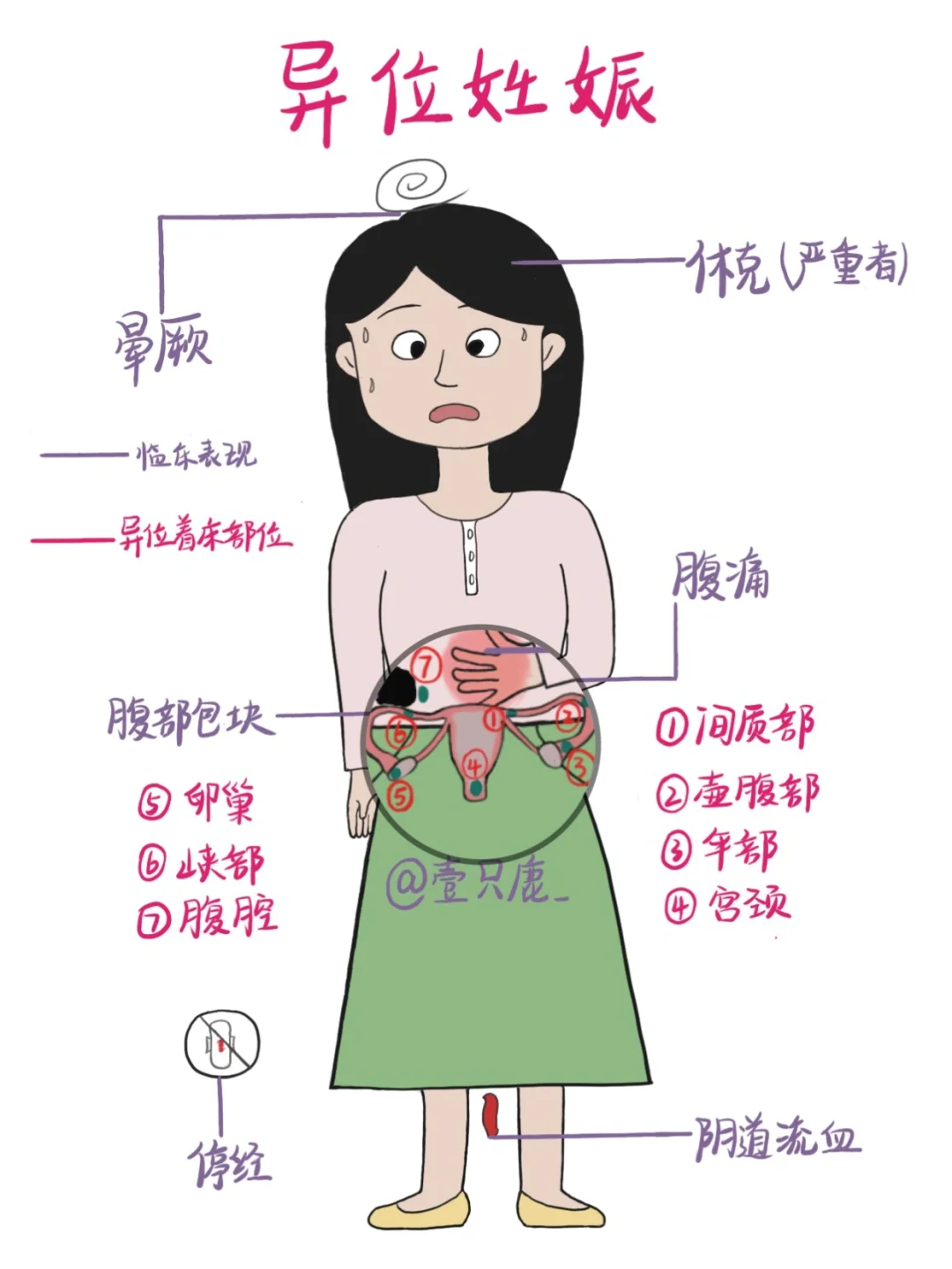 医学生笔记📒｜异位妊娠🧐