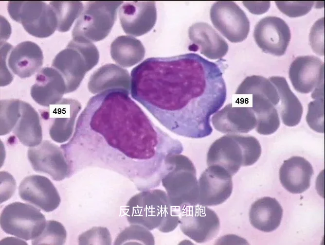 反应性淋巴细胞