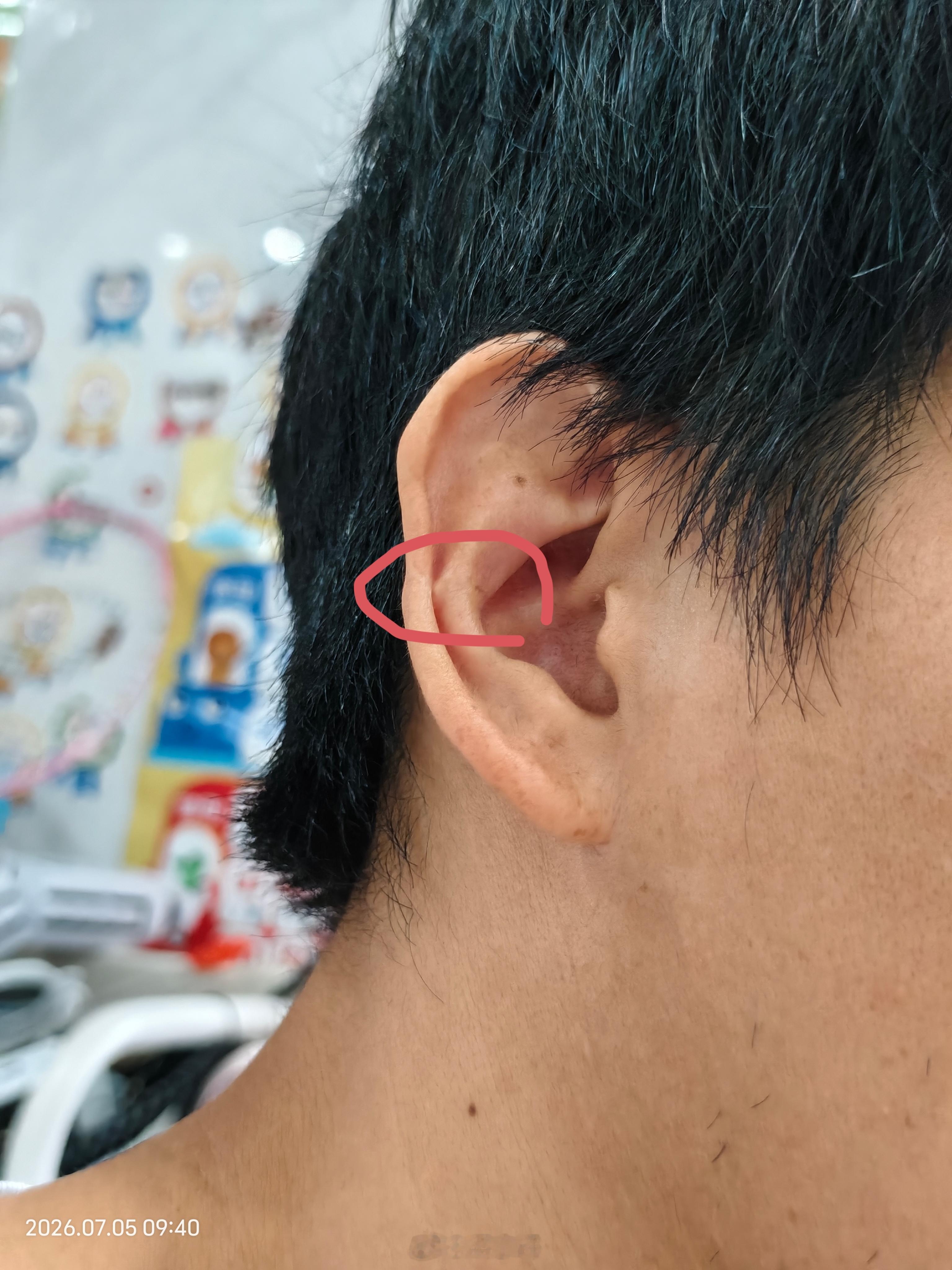王力宏缝了39针看着都很痛。在我读高中的时候跑楼梯一样摔倒了，当时缝了多少针就忘