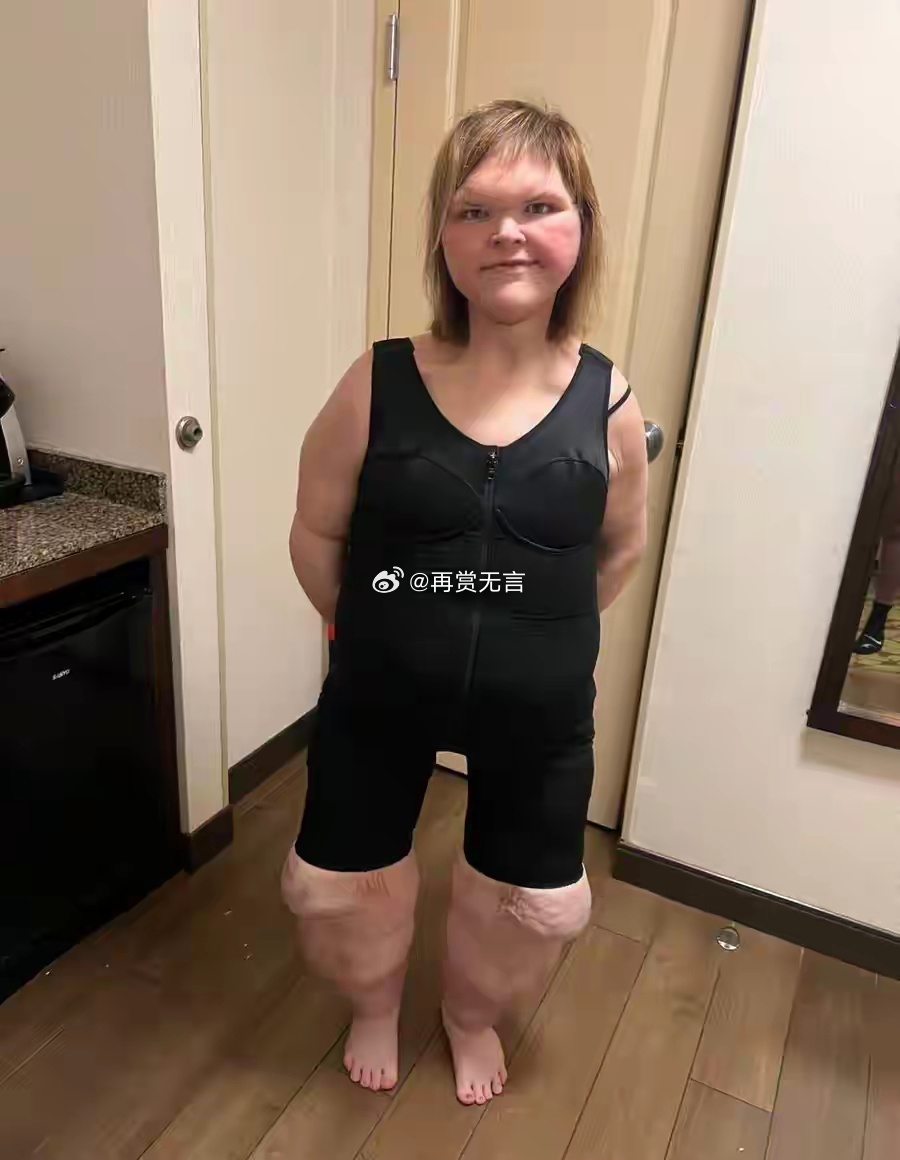 减肥要适度才行，还是之前的状态正常点！ 