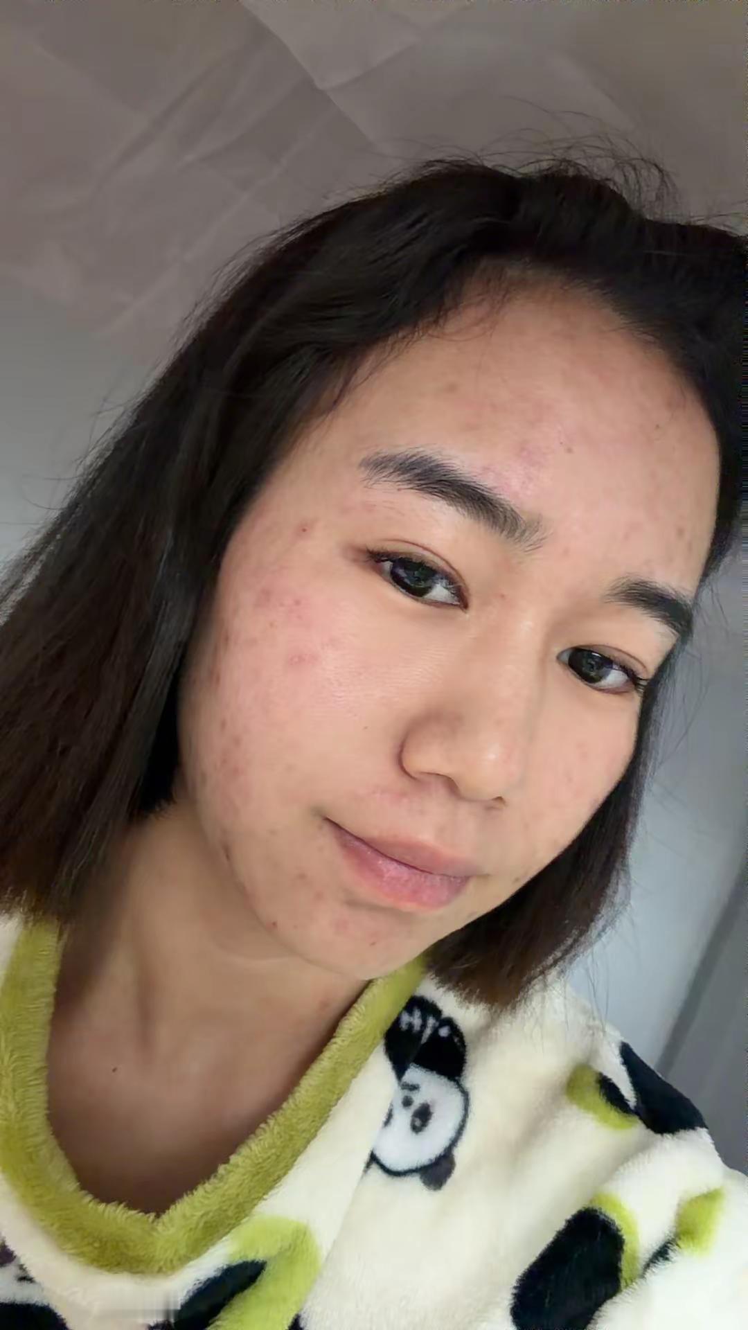 长痘的自卑是不敢直视别人的眼睛 我好像把我的自信弄丢了痘痘