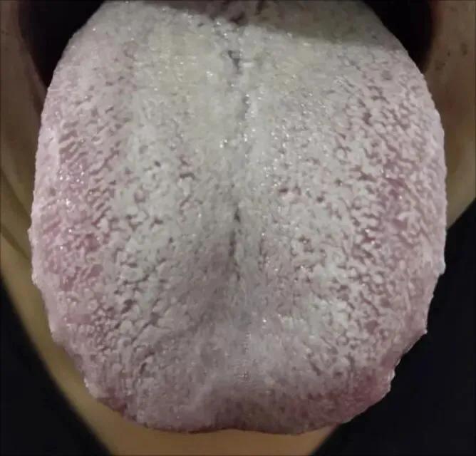 看这个舌象，如果不用大辛大热的药，比如说附子，肉桂，干姜等很难见效
看这个舌象：