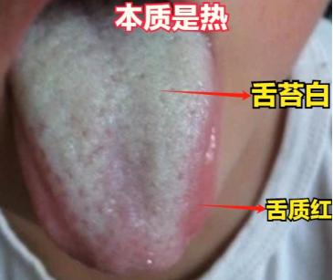 舌头又红又白，不知道是热还是寒？
 
只需记住一句话：舌苔是表象，舌质才是根本。