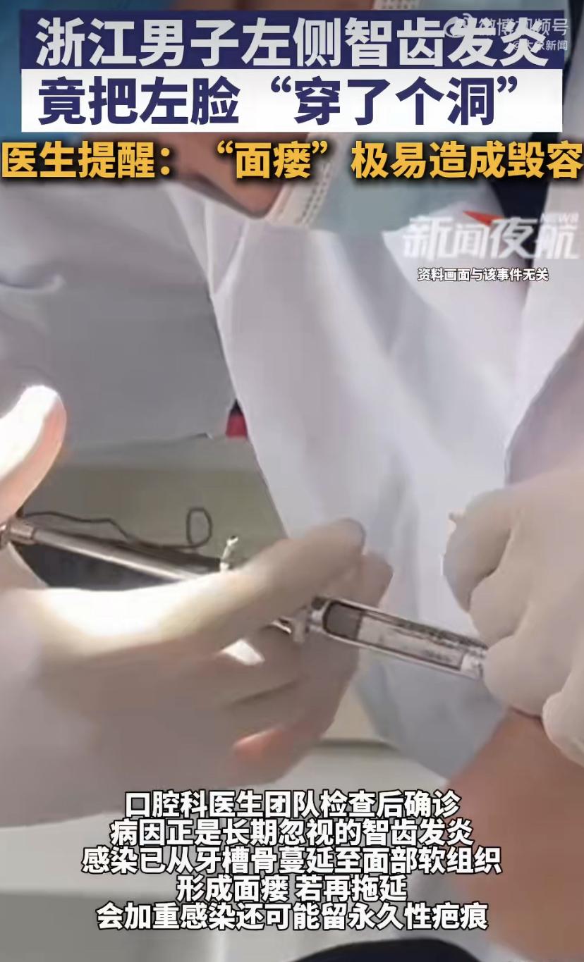 忍了几年牙疼，结果脸上烂出个洞!医生：这5种智齿别硬扛
浙江宁波的钱先生，左侧智