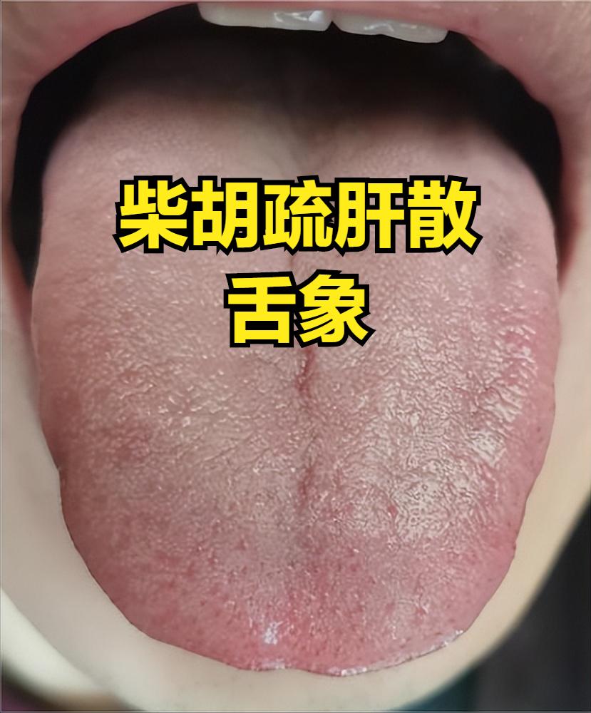 养肝分年龄！少年用柴胡，中年用龙胆，老年用四物，帮你养出好肝
1. 少年用柴胡疏