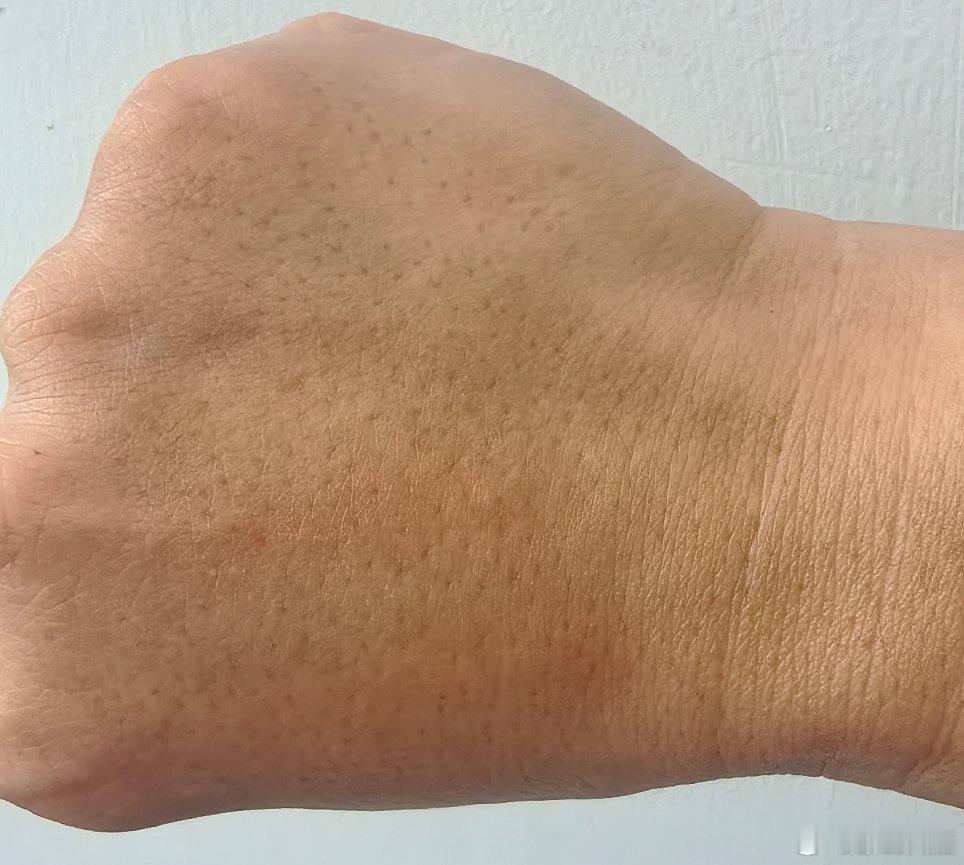 皮肤越黑越容易晒黑确实是哟，没有一年躲过的，没到夏天，就已经晒黑的没眼看了