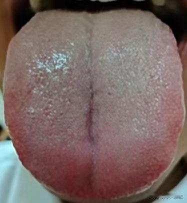舌苔越厚腻痰湿越重，痰湿不除，就别想着身体能补好

这是我们一位粉丝朋友的舌象，