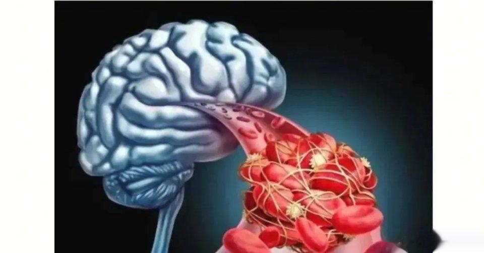脑梗恢复六个动作赶快学起来，在家也能做。一、握拳伸手，早晚各做100次。二、转动