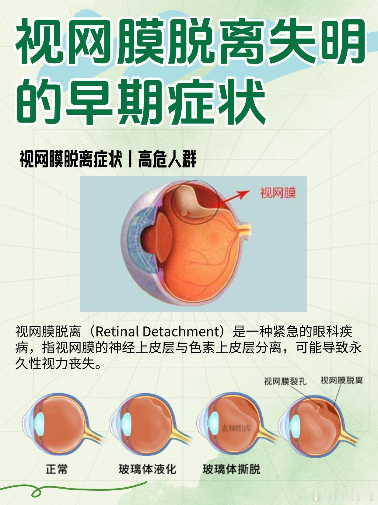 27岁程序员敲代码时视网膜脱离注意用眼过度，保护眼睛健康。 ​​​