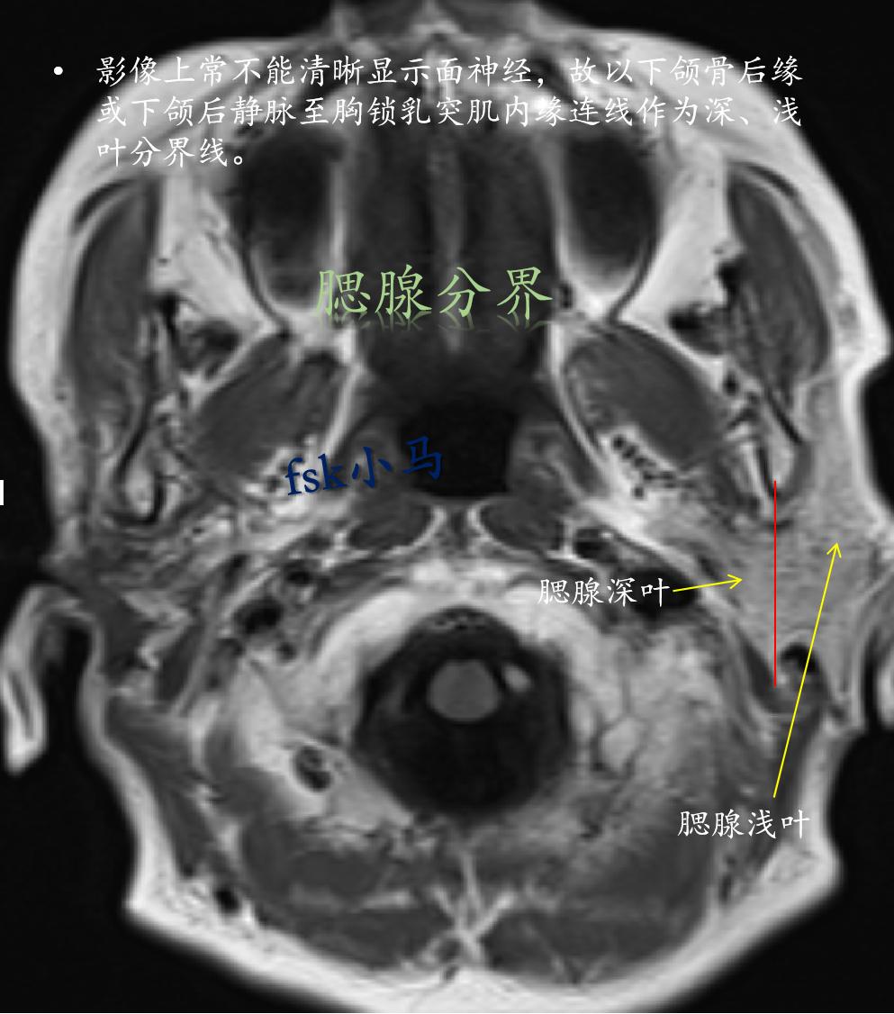 临床上以面神经为界，将腮腺分为两叶：浅叶(外侧)和深叶(内侧)。 影像...