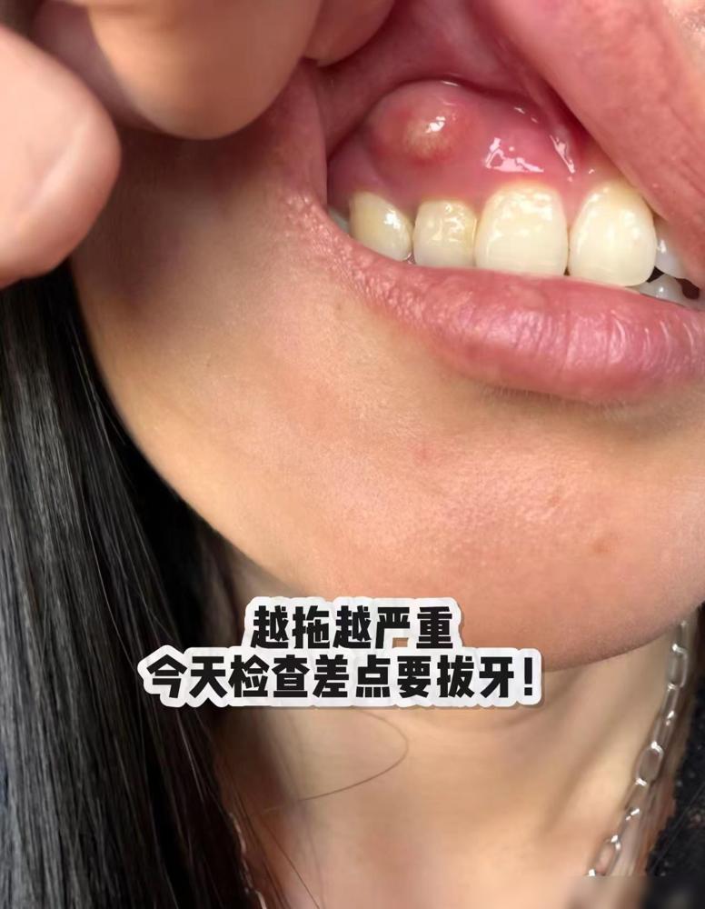 牙龈鼓了一个脓包，一开始没当回事，越拖越严重。

人到中年才发现，看牙最容易吃亏