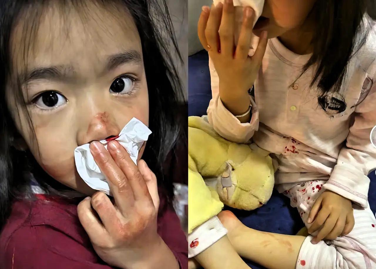 这次奶奶下手有点重了。

五岁孙女不会刷碗，被奶奶一巴掌打得流鼻血。父亲回家正好