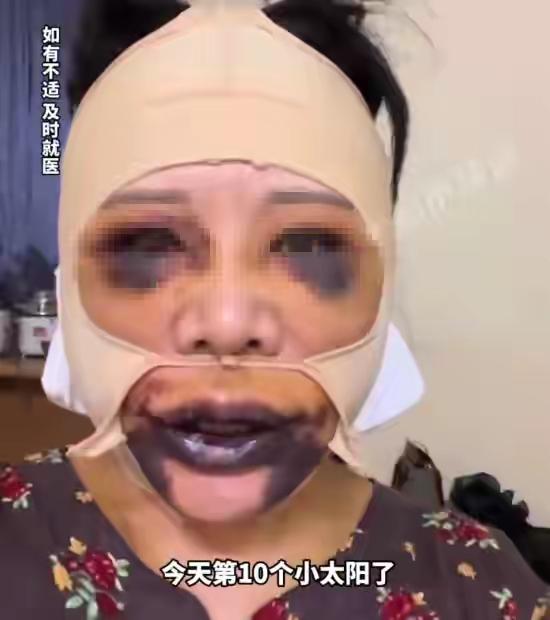 
上海58岁女子整容后肿成“熊猫”！面部大片淤血，眼睛和嘴巴肿胀发紫！10天还