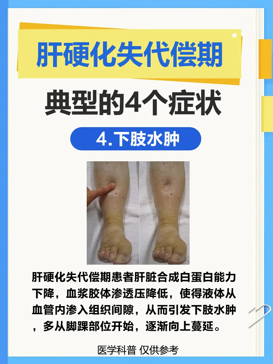肝硬化 抖出健康知识宝藏 肝腹水