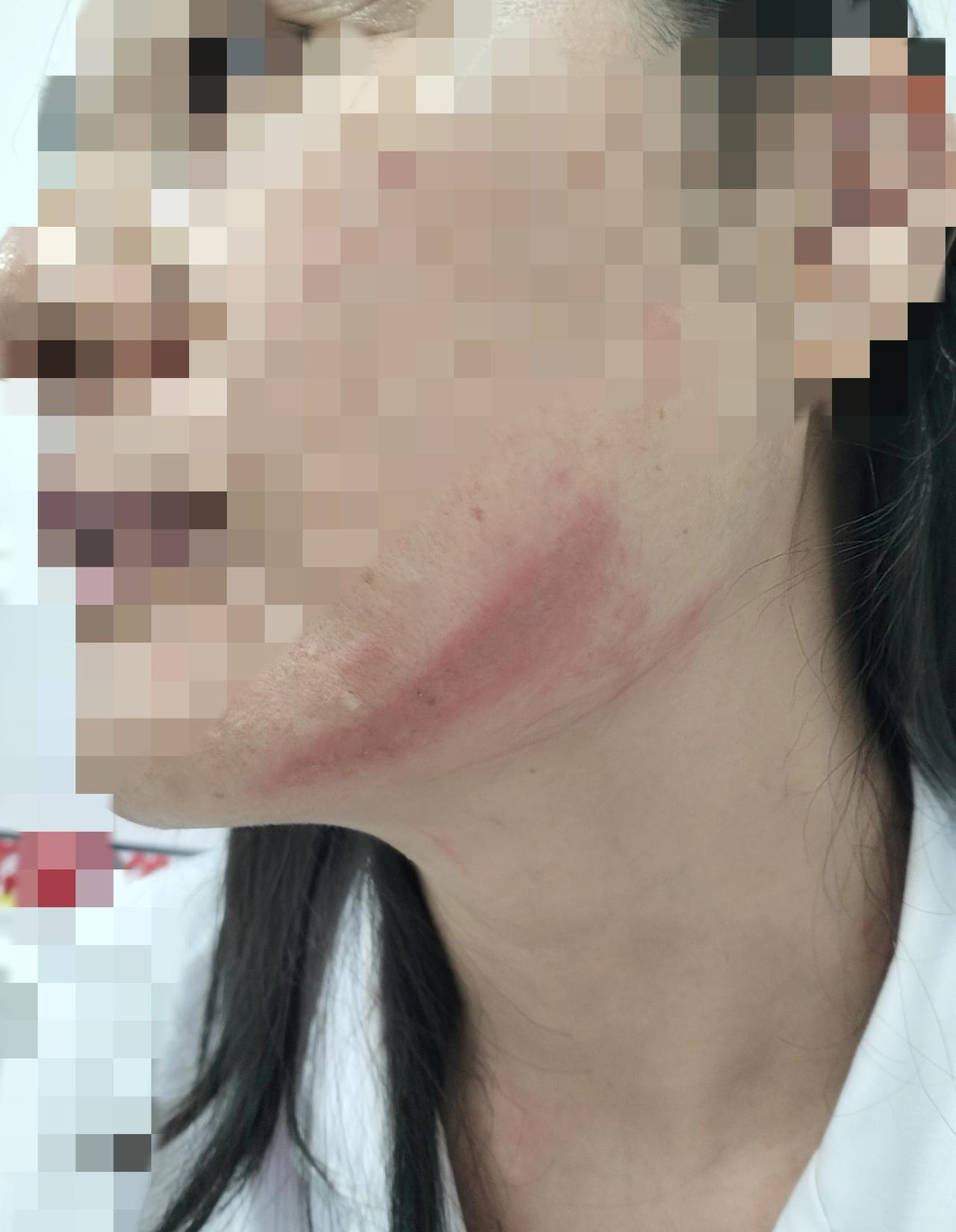 我同事最近倒了大霉，那阵子天天顶着一张红肿的脸来上班，可吓人了，大家都在问怎么一