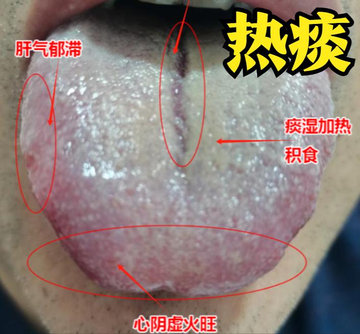 大家好，我是中医陈大夫！一上火、感冒后期，不少朋友就会被 “黄痰” 缠上 —— 