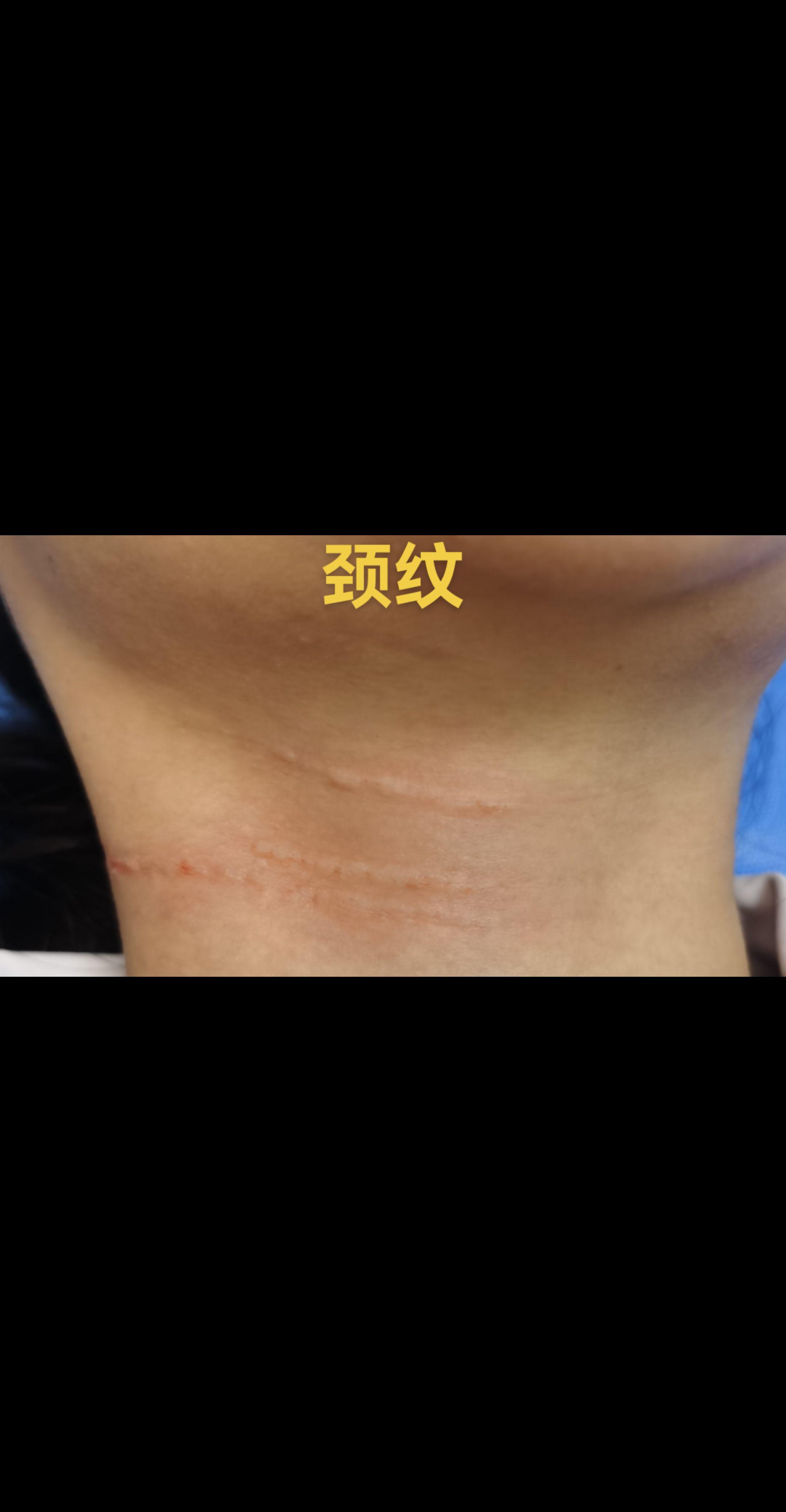 颈纹。