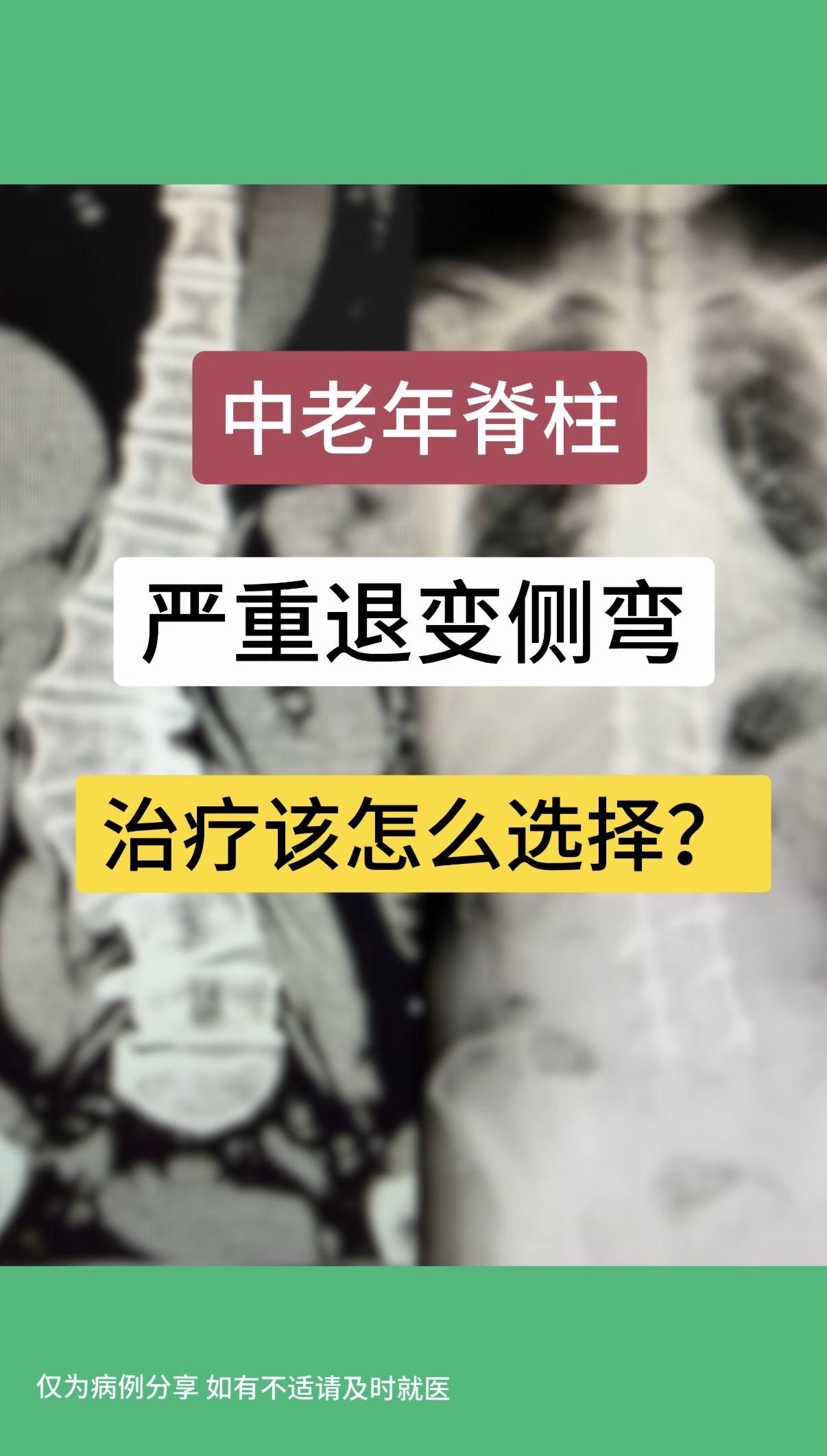 50多岁女性，腰痛5年，渐加重。现行走50米左右腰痛严重，需躺下或坐下...