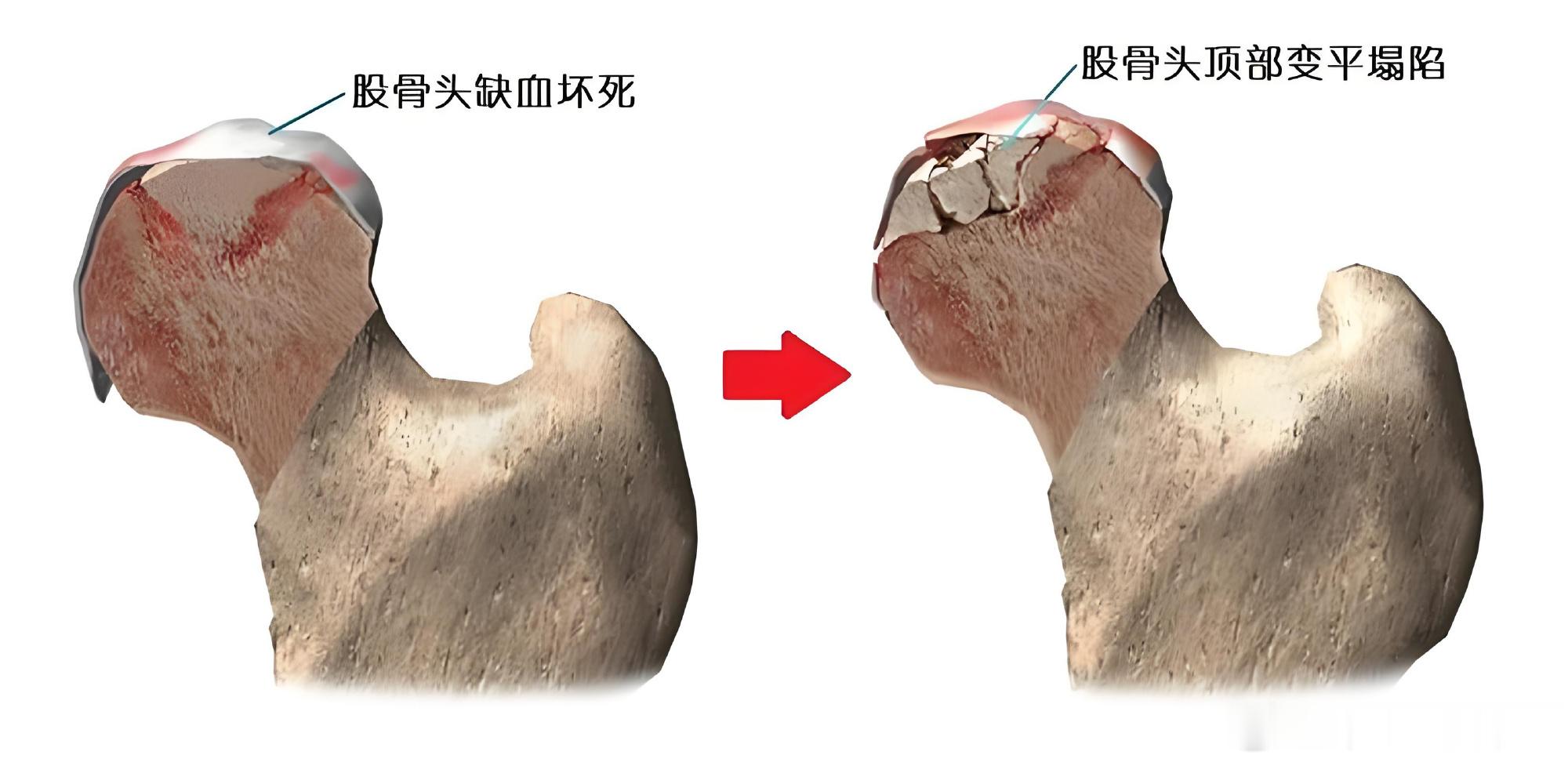 缺血性股骨头坏死是什么病 这个病听着不熟，其实挺折磨人。简单说就是股骨头血供出了