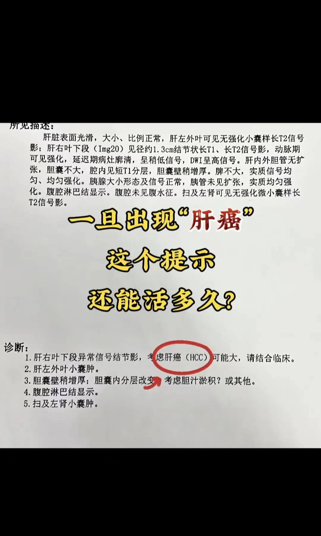 一旦出现肝癌这个提示，还能活多久？ 从医 20 年，我最怕见患者拿到肝...