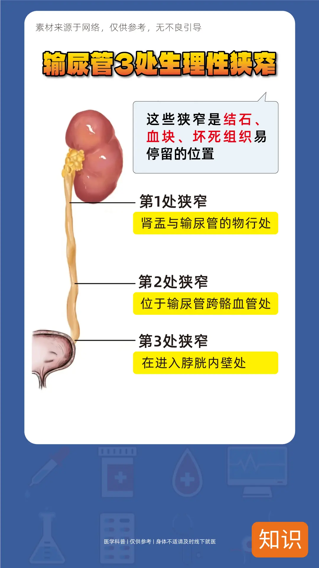 结石排到这三个地方最难排