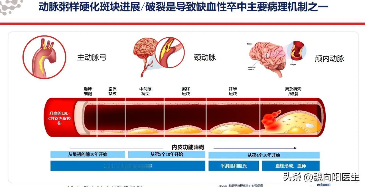 脑卒中反复复发的最主要危险因素：胆固醇控制不达标！
#卒中是否能治愈# 
脑卒中