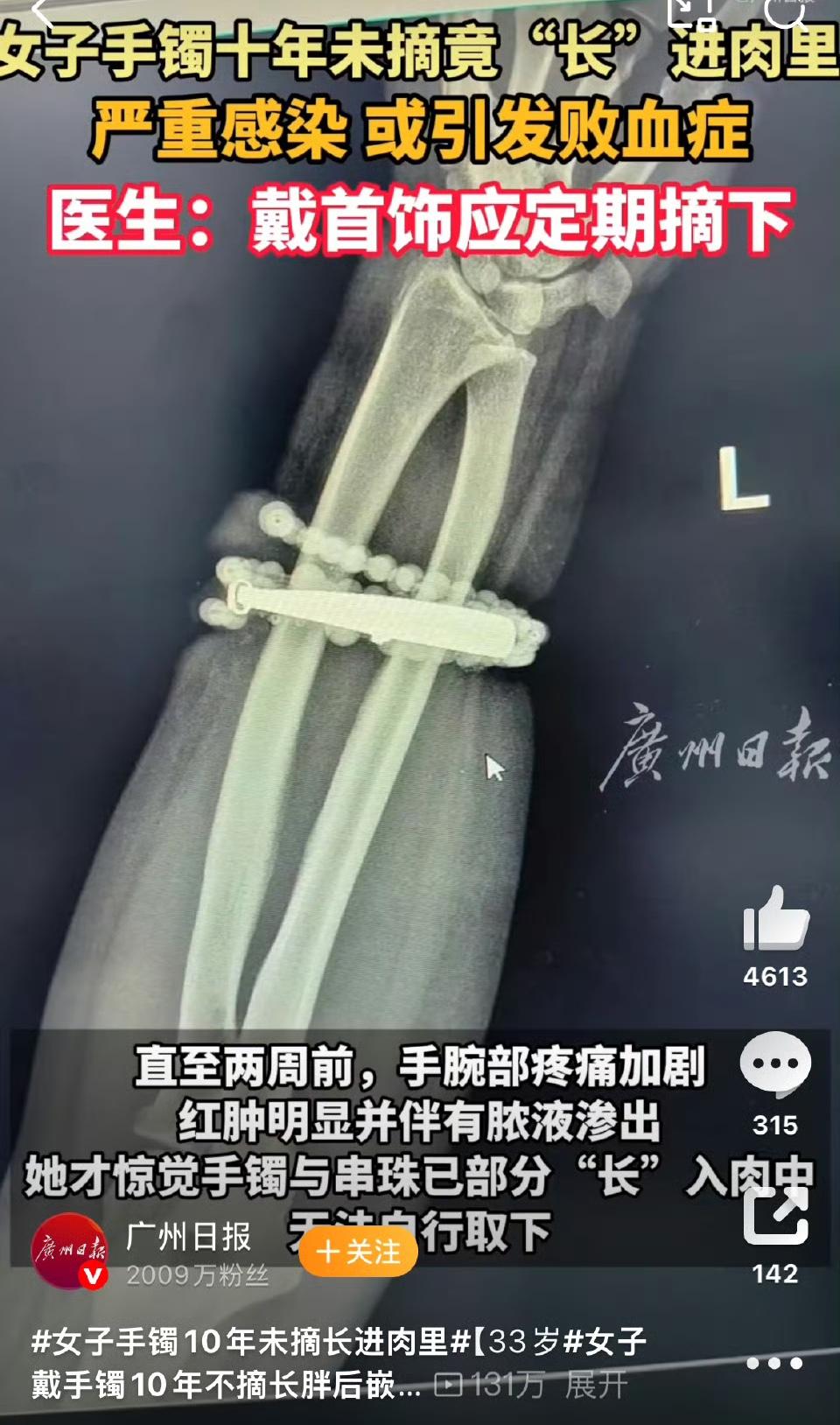 女子手镯10年未摘长进肉里
手镯是死的人是活的，带着觉得不对劲的时候就应该摘下来