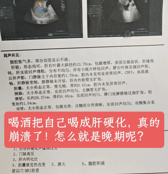 肝硬化晚期，真的崩溃了， 怎么就是晚期了呢？ 喝酒成果把自己喝成肝硬化...