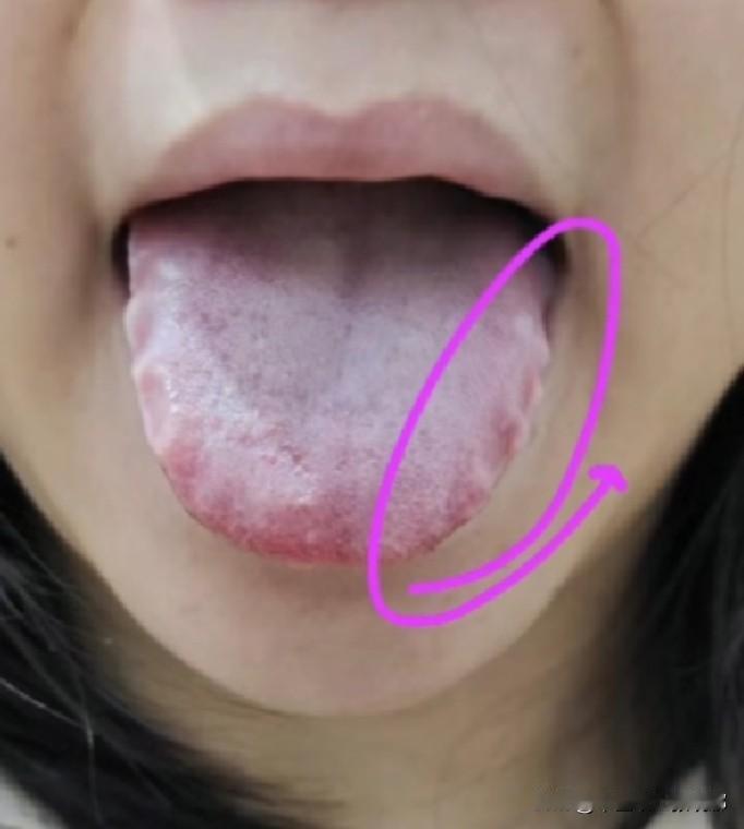 你也是这种舌象的话，千万不要再猛补了！身体像个大漏斗，越补越虚！！！

患者主诉