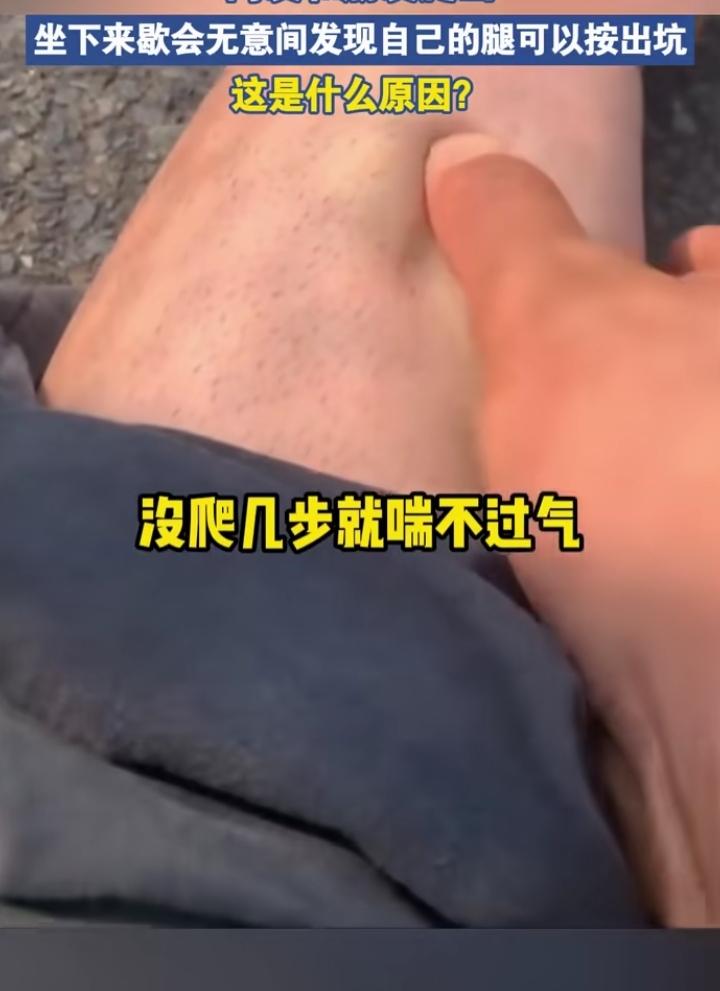 我们一帮人去爬山，一个朋友刚走不远就喊累！说腿没劲！腿上一按一个窝！这是怎么了？