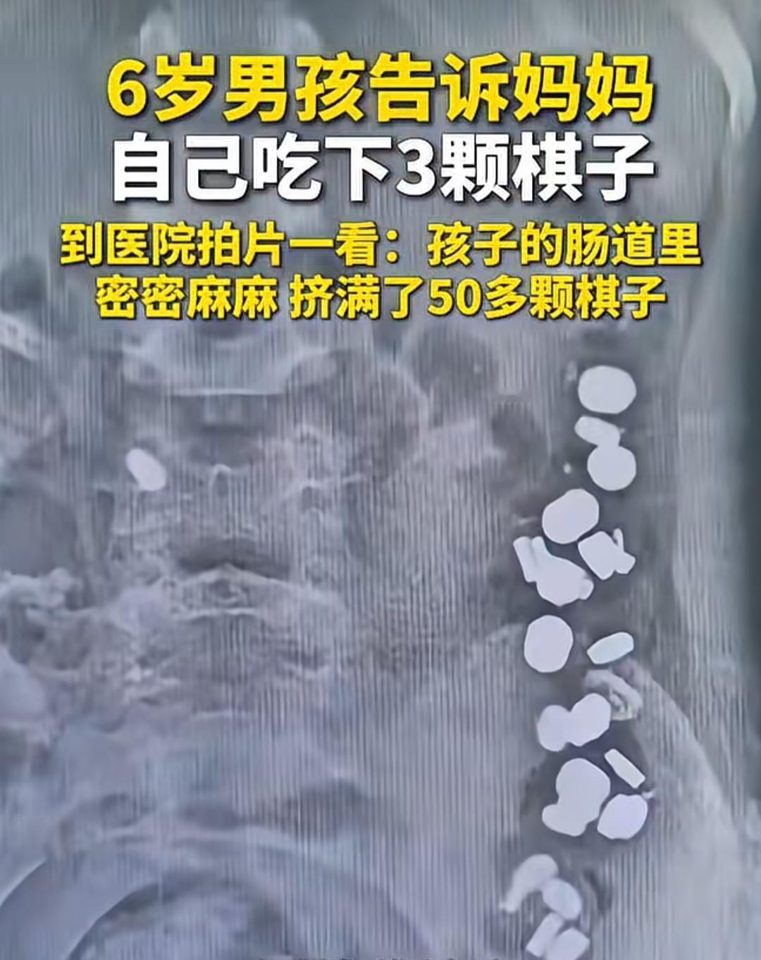 一张X光片，密密麻麻的棋子在孩子肠道里排成了“长龙”，让无数家长捏了一把冷汗。6