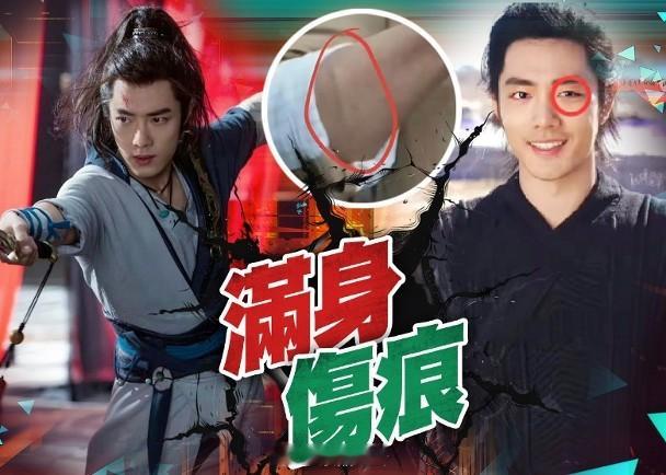 肖戰拍打戲受傷手臂縫7針　左眼角驚現瘀痕內地男神於賀歲片《射雕英雄傳：俠之大者》